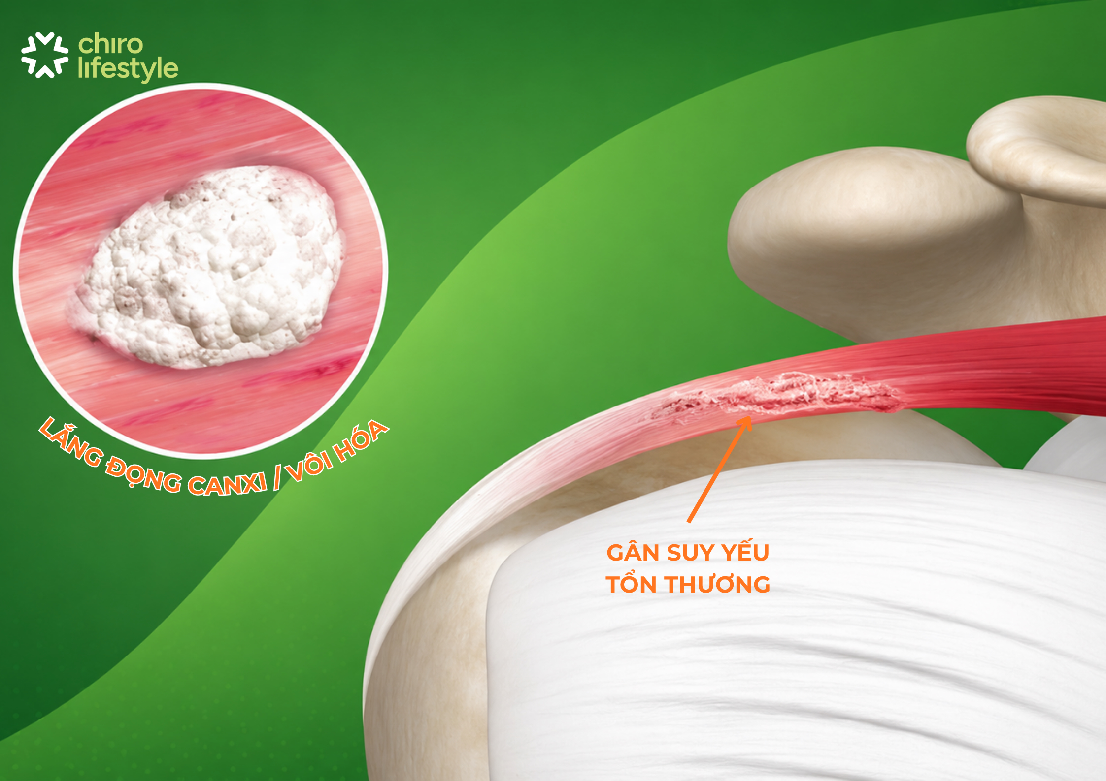 Gân suy yếu có thể gây vôi hóa
