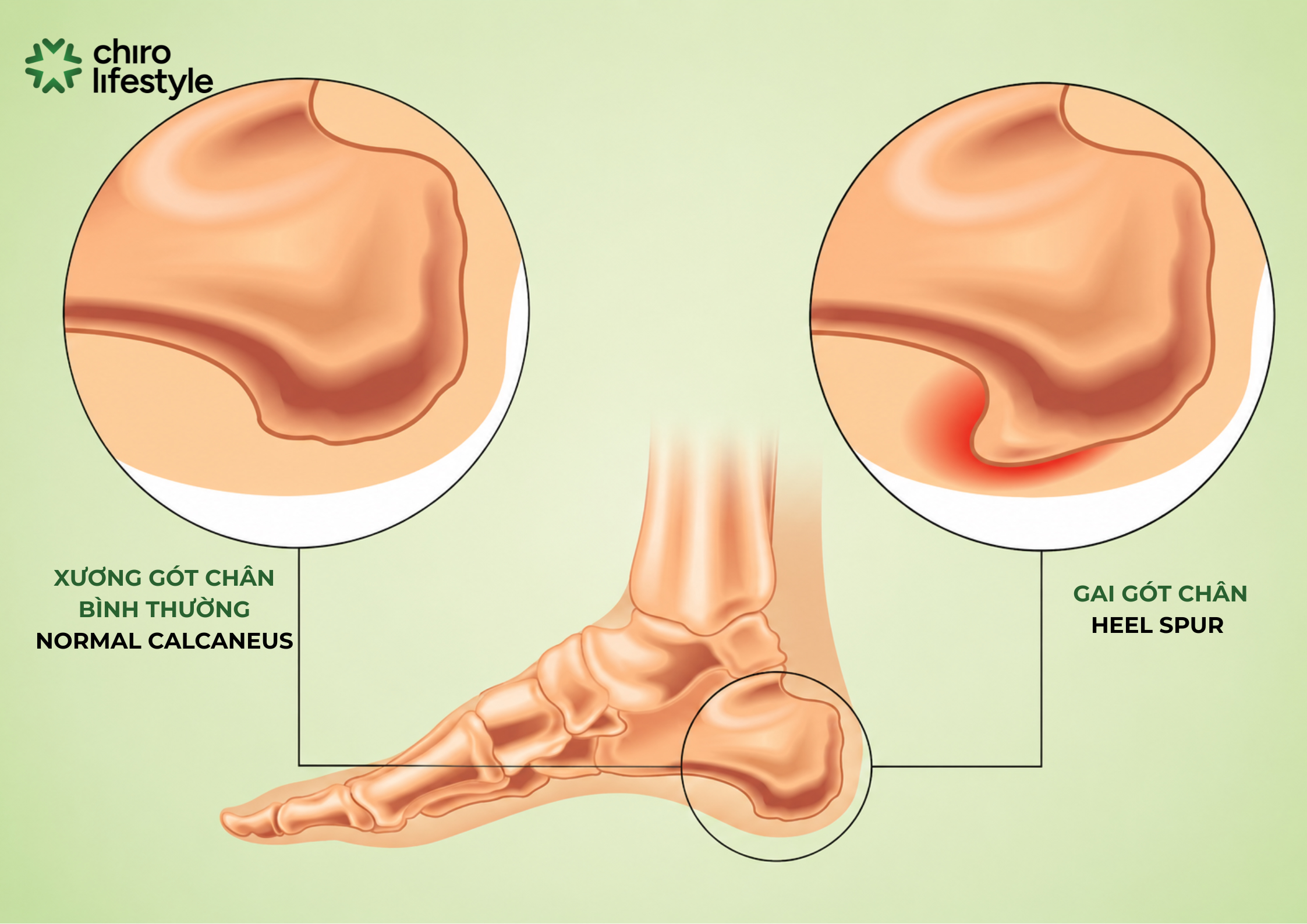 Bone spurs are extra bone growths that develop along the edges of existing bones.