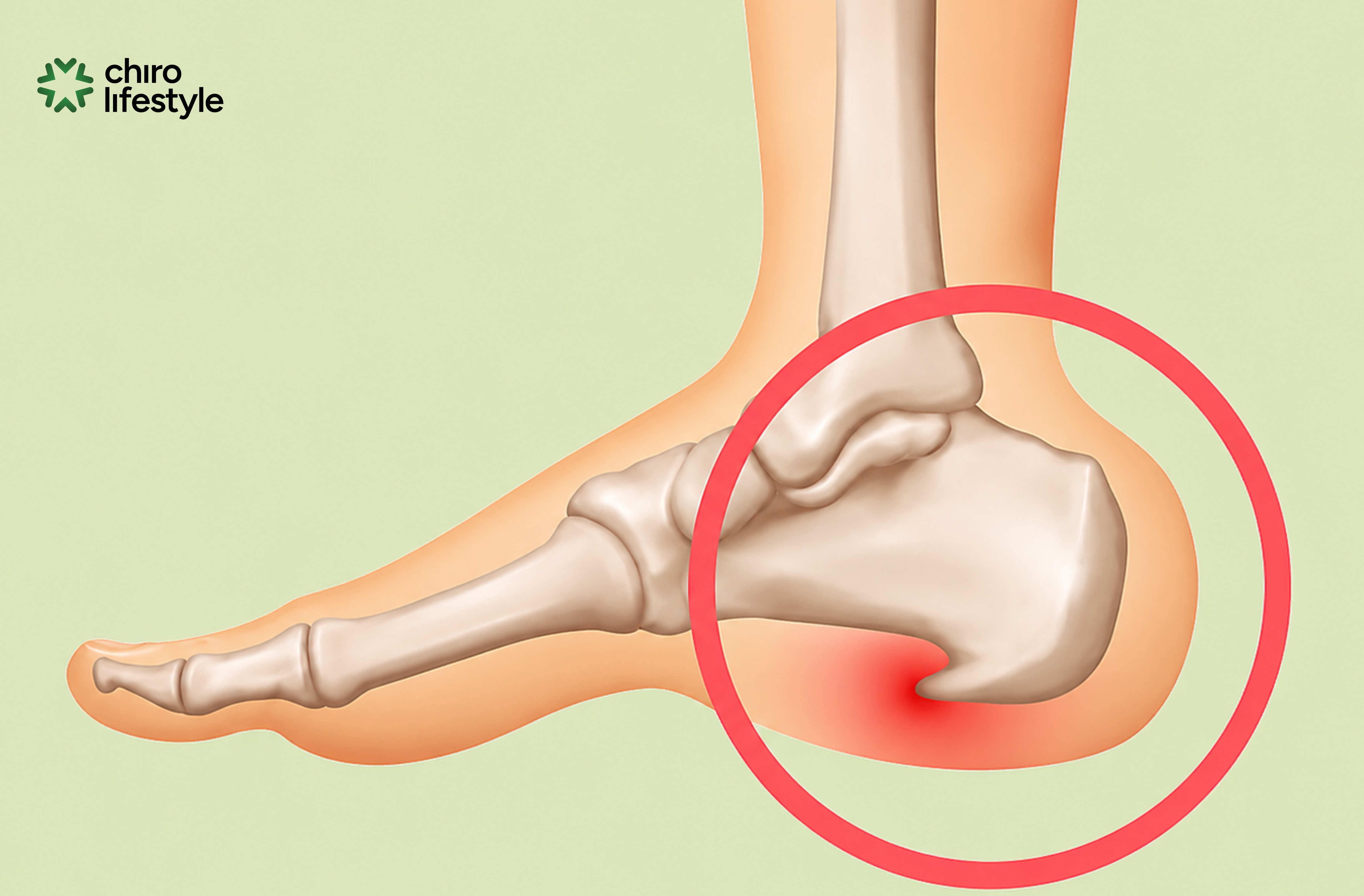 What Are Bone Spurs? How to Relieve Pain Without Surgery