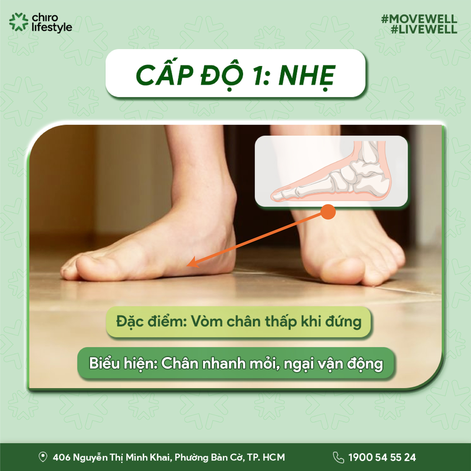 Cấp độ 1 (Nhẹ): Vòm chân thấp khi đứng