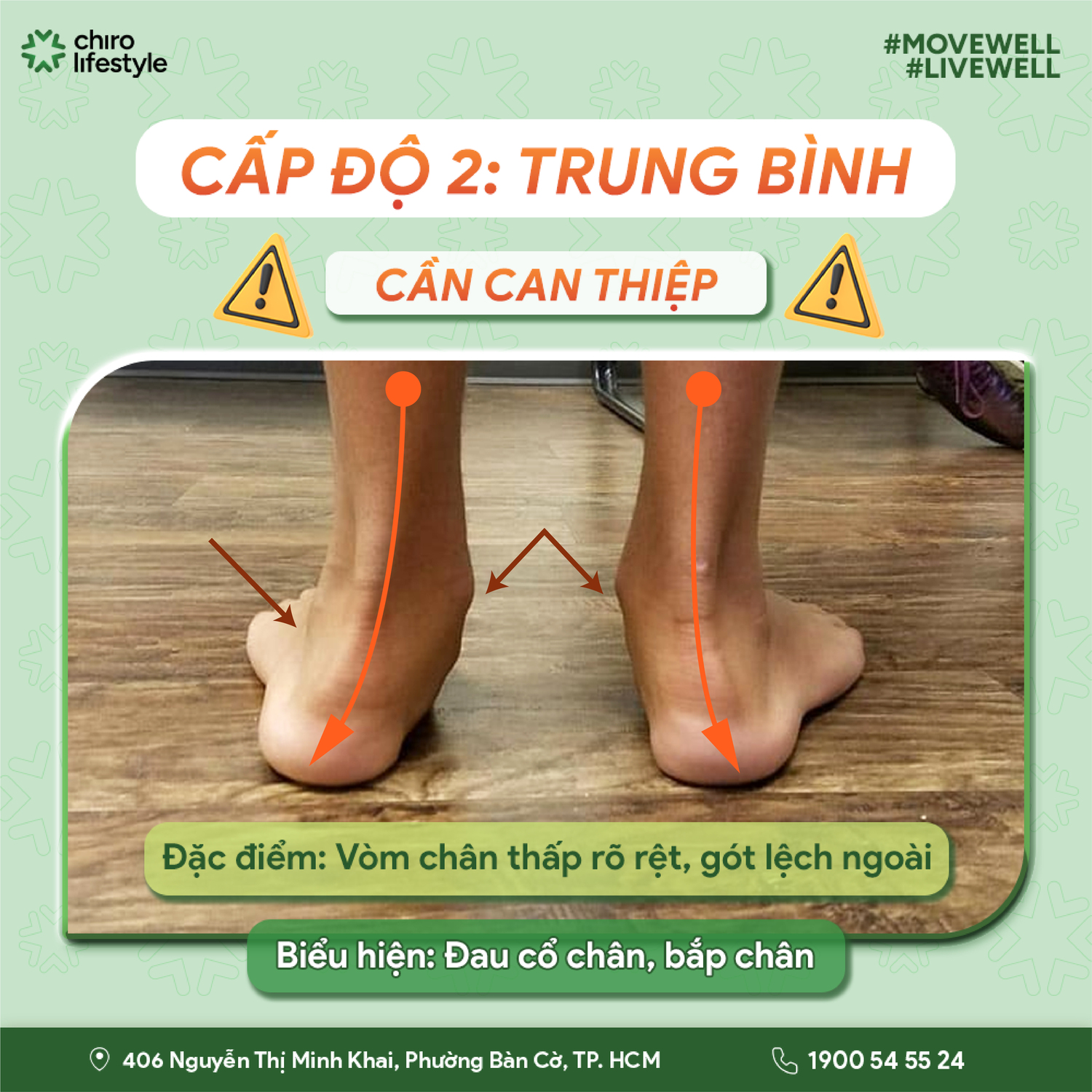 Cấp độ 2 (Trung bình): Vòm chân thấp rõ rệt, gót lệch ngoài