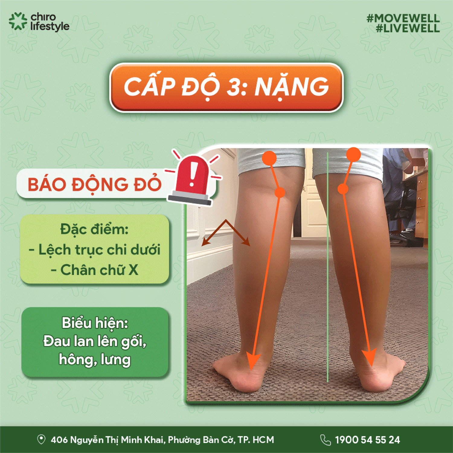 Cấp độ 3 (Nặng): Biến dạng lệch trục chi dưới
