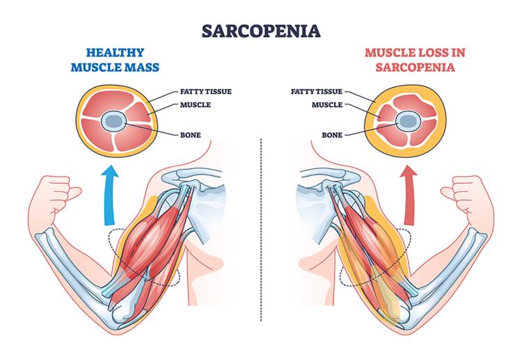 Sarcopenia: Causes, Diagnosis and Treatment with Physical Therapy